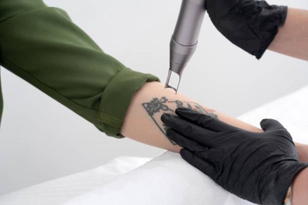 Safe and Effective Laser Tattoo Removal Services